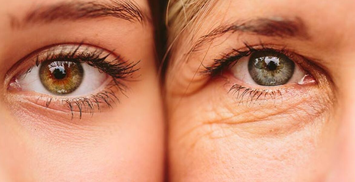 External signs of skin aging around the eyes of two women of different ages