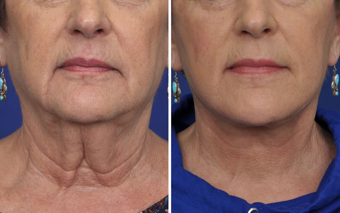 Before and after skin rejuvenation surgery