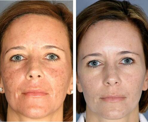 Before and after facial pyrolysis