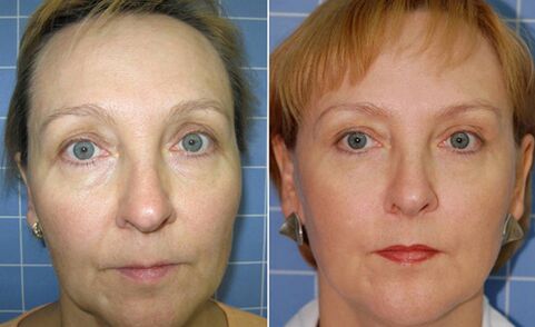 Before and after fractional laser facial repair