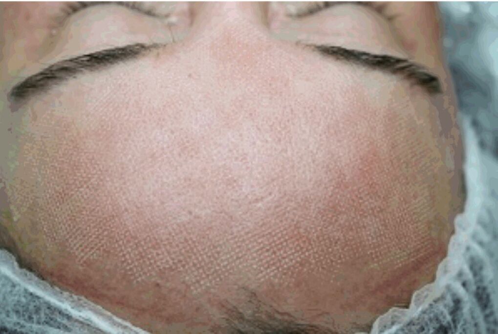Redness and slight swelling of the skin after fractional laser irradiation