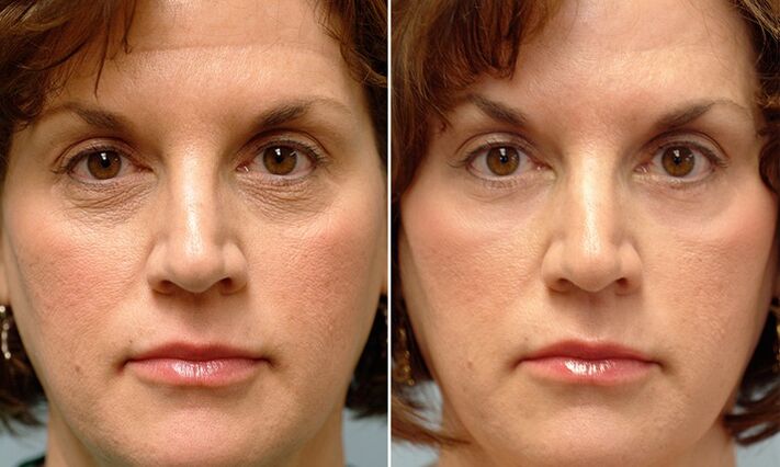 Face before and after laser wavelet restoration