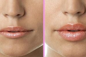 Before and after lip repair surgery