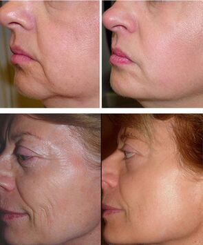Photos before and after laser revitalization